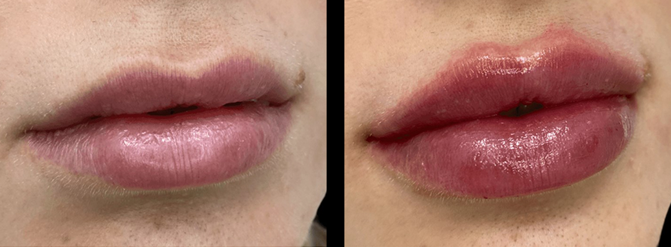 beautiful patient before and after results from Juvederm in Fort Lauderdale, FL