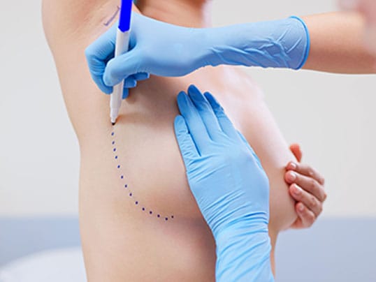 doctor preparing patient for her breast augmentation in Florida